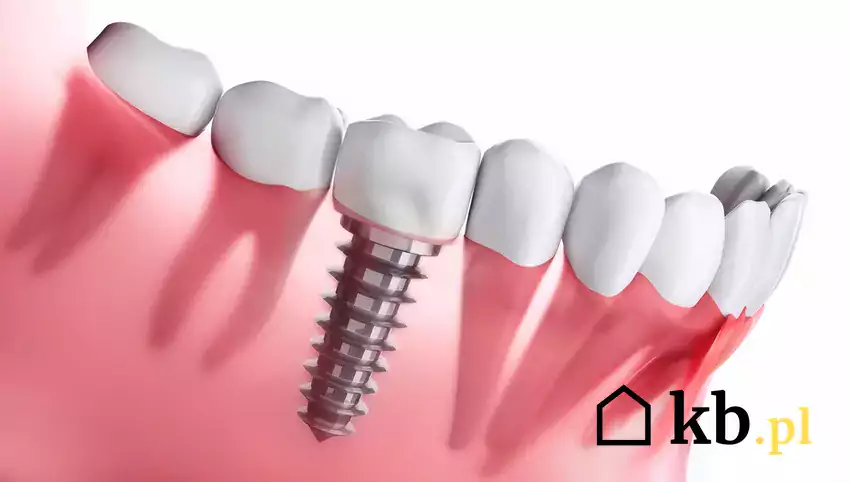 Ceny implantów zębów 2024