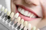 Cennik wybielania zębów 2024 Polska