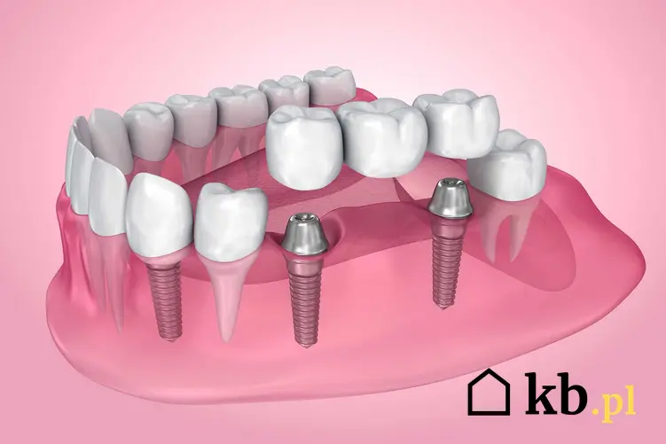 Implant zęba czasami jest niezbędny do założenia całej korony. Sprawdź cenę korony zęba i implantu.