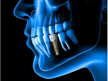 Ilustracja artykułu cena korony zęba 2024 - sprawdź cenniki dentystów w twoim mieście