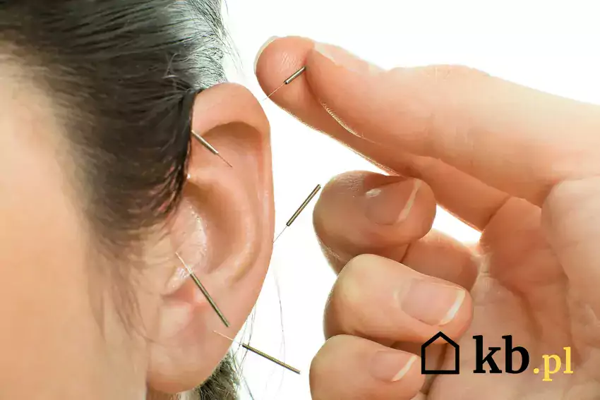 Igły akupunkturowe w uchu
