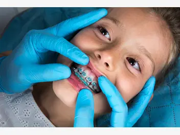Zdjęcie ilustrujące cennik ortodontów - sprawdź lokalne ceny aparatów na zęby