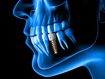 Cena korony zęba 2023 - sprawdź cenniki dentystów w Twoim mieście