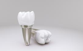 Cena implantów zębowych w 2021 roku. Poznaj cennik!