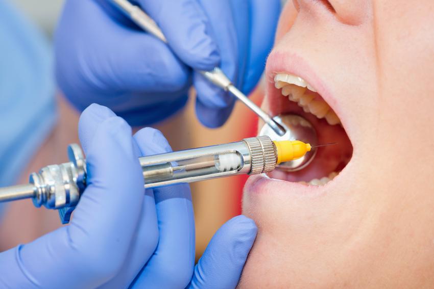 Uśredniona stawka znieczulenia miejscowego przed zabiegiem dentystycznym.  Usługi stomatologiczne zwolnione z podatku VAT. 