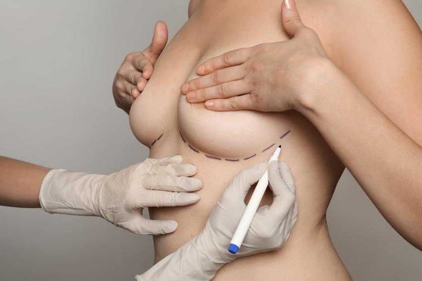 Średni koszt powiększania piersi. Implanty okrągłe. Opisany zabieg powiększenia biustu dotyczy ceny operacji w sprawdzonej klinice.